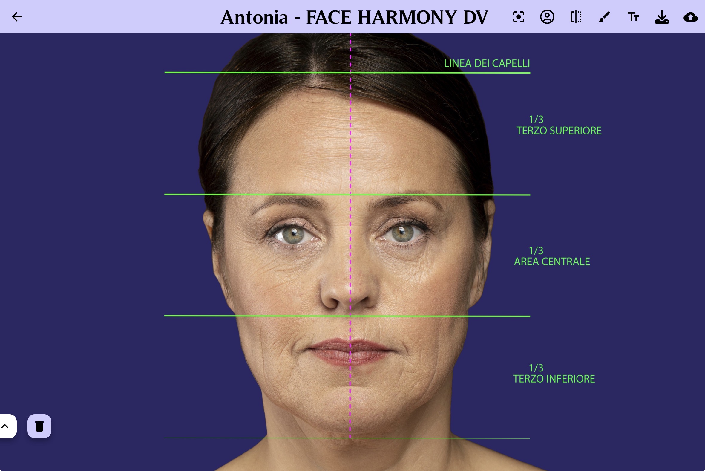 Scorcio dell’analisi morfologica Face Harmony DV con linee di simmetria e proporzioni del volto